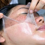 "Peeled Clear of Melasma" with 1 Patch? The Medical Truth from a Sante Dermatologist