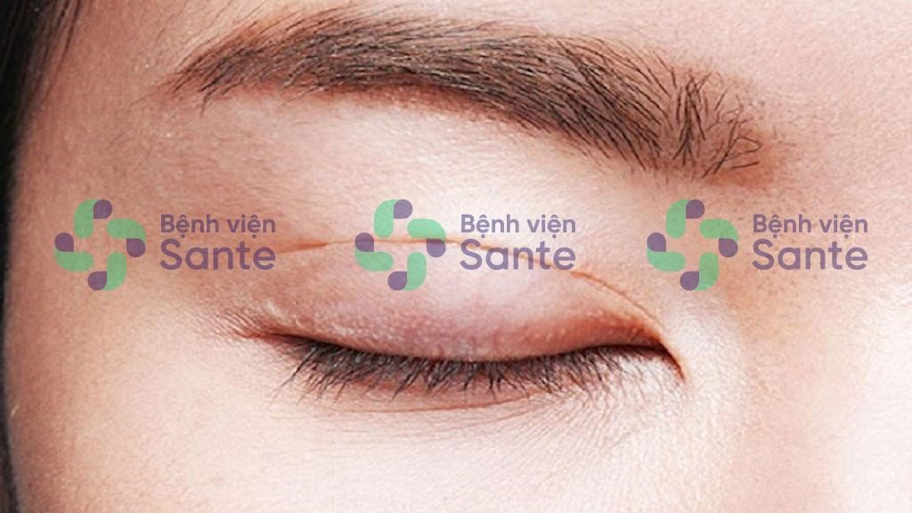 Bệnh viện phẫu thuật chỉnh hình cắt mí mắt tại TPHCM ở đâu tốt nhất Bệnh viện phẫu thuật chỉnh hình cắt mí mắt tại TPHCM ở đâu tốt nhất