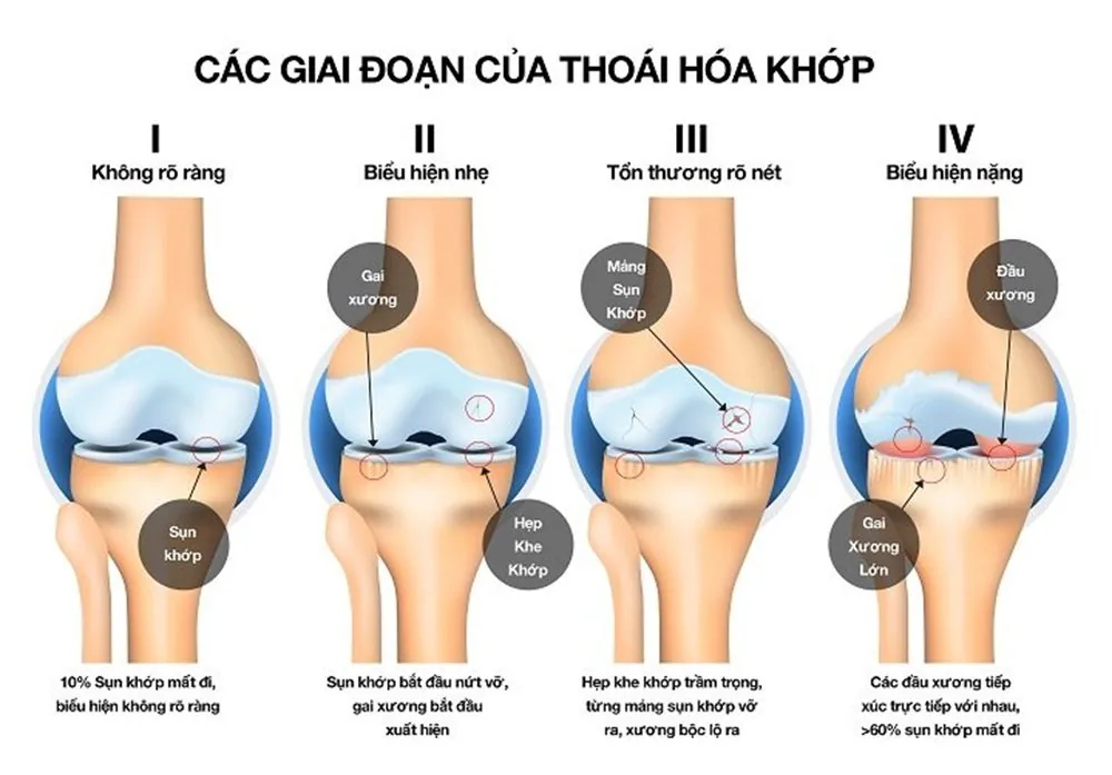 Bệnh viện Sante - Thoái hóa khớp