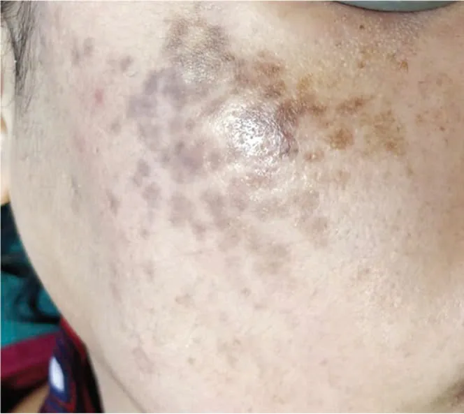 HORI'S NEVUS AND INSIGHTS YOU MAY NOT KNOW - Image 3 - SANTE Hospital Binh Thanh, HCMC