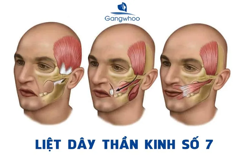 LIỆT DÂY THẦN KINH SỐ 7 NGOẠI BIÊN, MỘT CĂN BỆNH KHIẾN  GƯƠNG MẶT BỊ BIẾN DẠNG - Hình 2 - Bệnh viện SANTE Bình Thạnh, TP.HCM