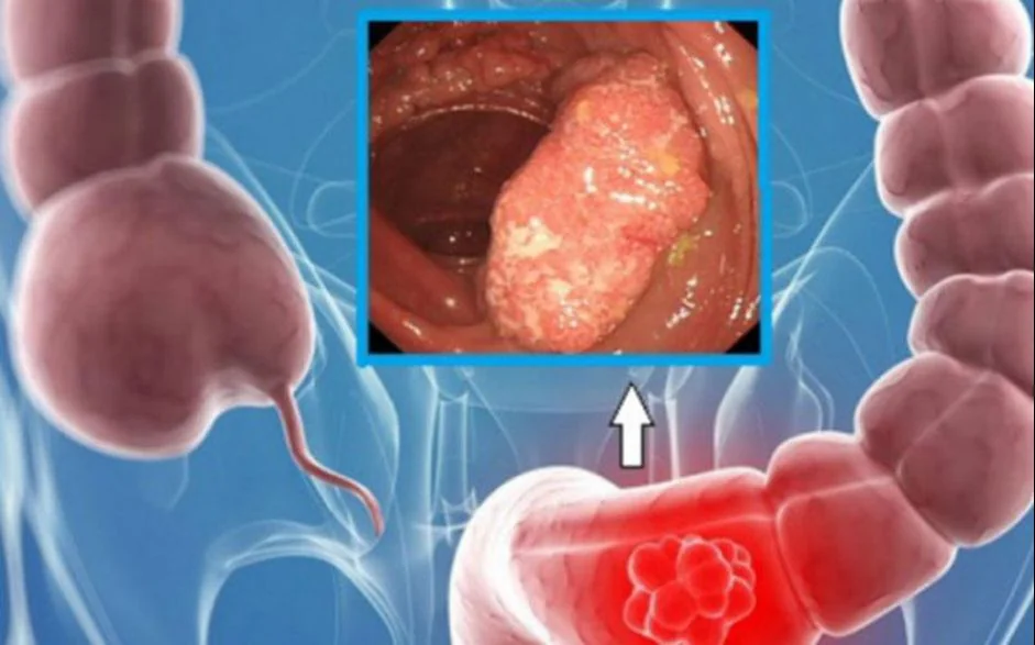 Colorectal Cancer Screening Modalities - Image 2 - SANTE Hospital, Binh Thanh, HCMC