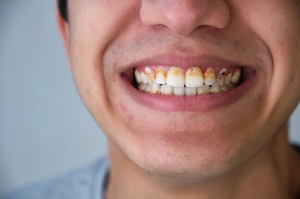 Sante Hospital - Porcelain Veneers (Dental Veneers) (Image 4) Sante Hospital - Porcelain Veneers (Dental Veneers) (Image 4)
