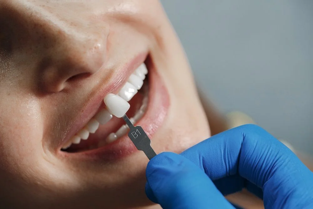 SANTE Hospital - Porcelain Veneers SANTE Hospital - Porcelain Veneers