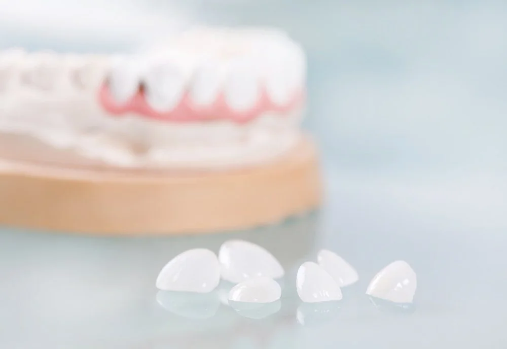 Sante Hospital - Porcelain Veneers (Dental Veneers) (Image 2) Sante Hospital - Porcelain Veneers (Dental Veneers) (Image 2)