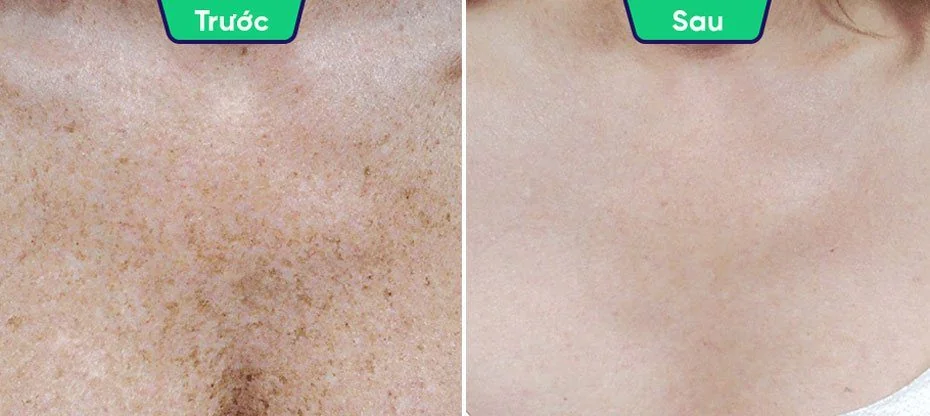 Skin treatments: melasma, freckles, acne, facelift, skin rejuvenation, and hair removal