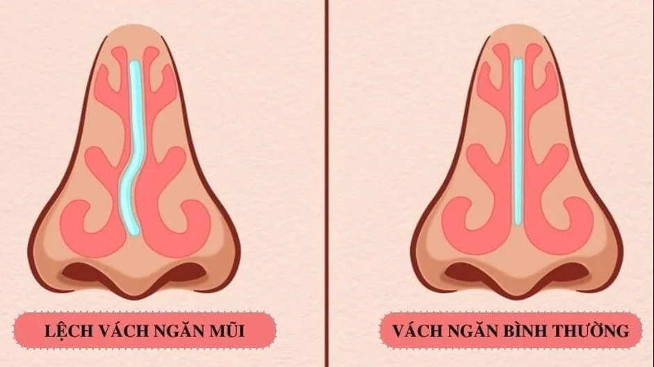 LỆCH VÁCH NGĂN MŨI KHI NÀO CẦN PHẪU THUẬT ? - Bệnh viện SANTE Bình Thạnh, TP.HCM