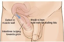 Bệnh viện Sante - Bệnh thoát vị bẹn