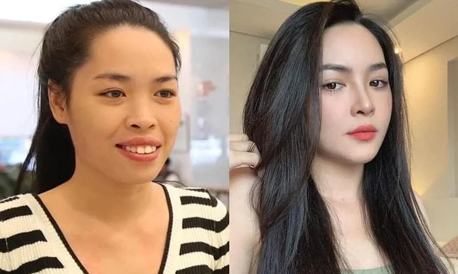 Bệnh viện Sante - Phẫu thuật thẩm mỹ thay đổi hoàn toàn gương mặt (Hình 4)