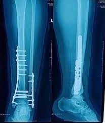 Open reduction and internal fixation (ORIF) with plate and screws Plate and screw osteosynthesis - SANTE Hospital Binh Thanh, HCMC