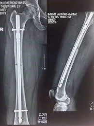 Intramedullary nailing fixation Intramedullary nailing osteosynthesis - SANTE Hospital Binh Thanh, HCMC