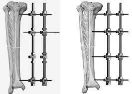 External frame fixation External fixation osteosynthesis - SANTE Hospital Binh Thanh, HCMC