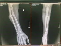Forearm fracture X-ray image X-ray image of forearm fracture - SANTE Hospital, Binh Thanh District, HCMC