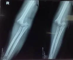 Displaced fracture Displaced fracture - SANTE Hospital Binh Thanh, HCMC
