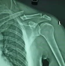 Displaced clavicle fracture with fragment Displaced clavicle fracture with fragment - SANTE Hospital Binh Thanh, HCMC