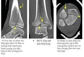 CT scan of distal tibial fracture Distal tibial fracture CT scan - SANTE Hospital Binh Thanh, HCMC