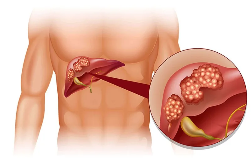 Bệnh viện Sante - Triệu chứng ung thư gan_ nguyên nhân_ đối tượng dễ mắc bệnh