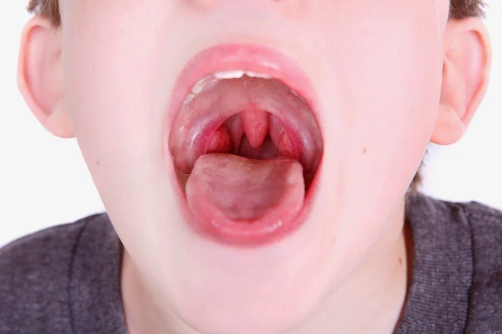 Bệnh viện Sante - Viêm amidan là gì? Nguyên nhân_ triệu chứng và cách điều trị (Hình 2)