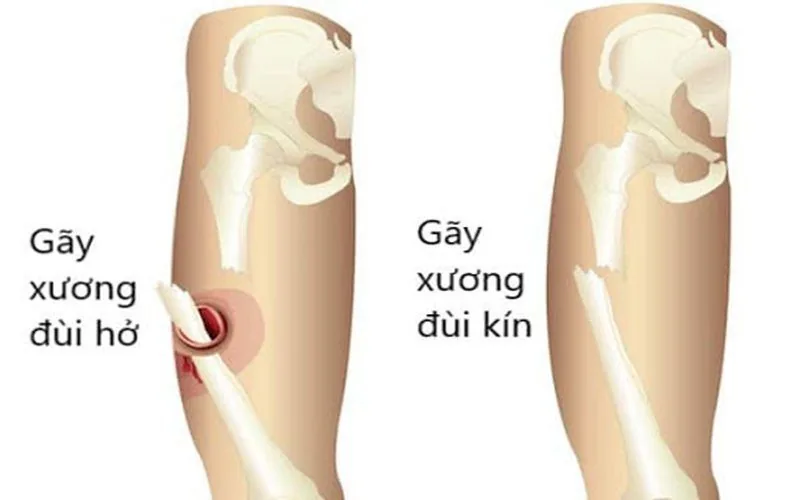 Femoral fracture Femur fracture - SANTE Hospital, Binh Thanh District, HCMC