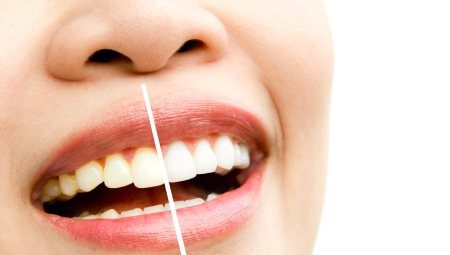 Professional Teeth Whitening