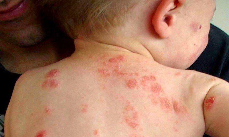 Chốc lở ở trẻ có nguy hiểm không? Dấu hiệu và cách chăm sóc
