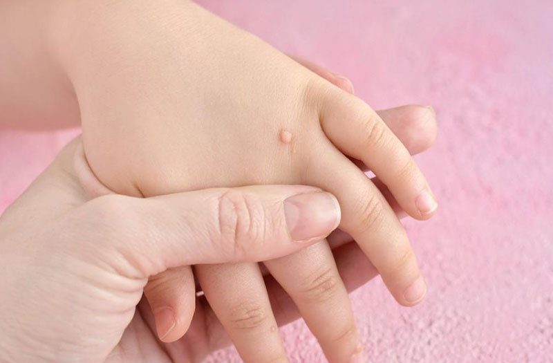 Mụn cóc ở trẻ rất dễ gặp: Nguyên nhân và cách điều trị hiệu quả