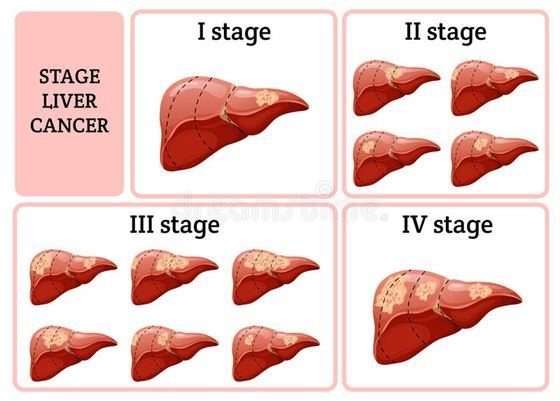 Các giai đoạn ung thư gan dựa vào phân tích, chẩn đoán