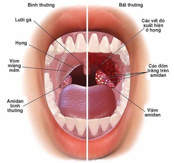 Nguyên nhân nào dẫn đến đau họng? Triệu chứng, cách chữa trị