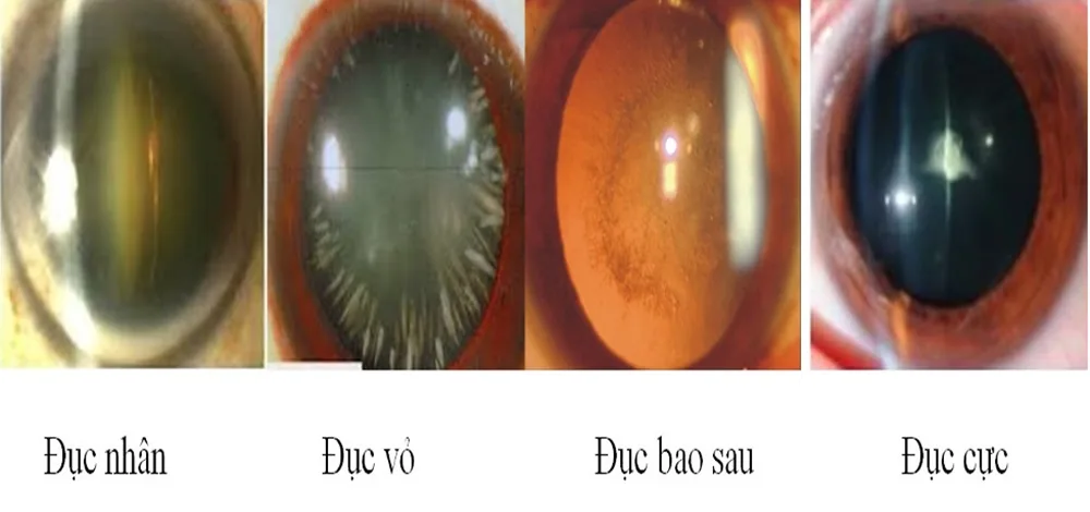 Những bệnh lý nguy hiểm thường gặp ở mắt ai cũng nên cảnh giác - Hình 7 - Bệnh viện SANTE Bình Thạnh, TP.HCM Những bệnh lý nguy hiểm thường gặp ở mắt ai cũng nên cảnh giác - Hình 7 - Bệnh viện SANTE Bình Thạnh, TP.HCM