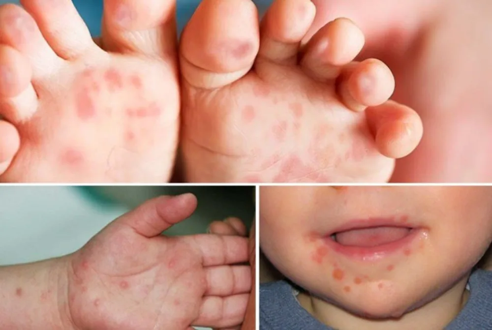 PHÒNG NGỪA BỆNH TAY CHÂN MIỆNG CHO TRẺ - Hình 2 - Bệnh viện SANTE Bình Thạnh, TP.HCM