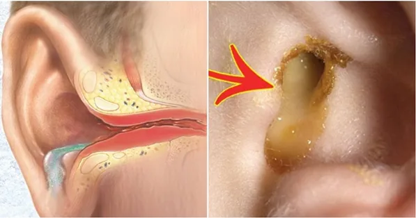 Tai chảy mủ có nguy hiểm không và cách xử lý khi tai bị chảy mủ - Hình 2 - Bệnh viện SANTE Bình Thạnh, TP.HCM Tai chảy mủ có nguy hiểm không và cách xử lý khi tai bị chảy mủ - Hình 2 - Bệnh viện SANTE Bình Thạnh, TP.HCM