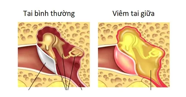 Tai chảy mủ có nguy hiểm không và cách xử lý khi tai bị chảy mủ - Bệnh viện SANTE Bình Thạnh, TP.HCM Tai chảy mủ có nguy hiểm không và cách xử lý khi tai bị chảy mủ - Bệnh viện SANTE Bình Thạnh, TP.HCM