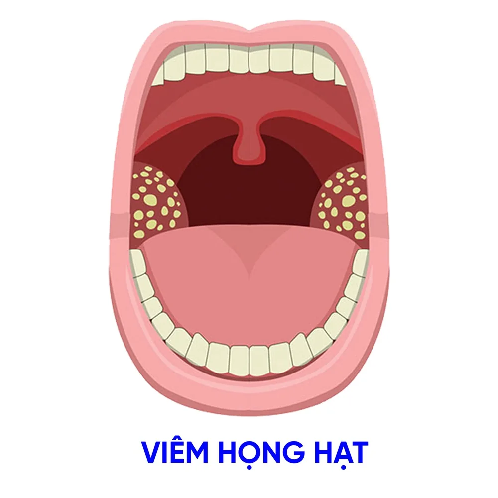 Viêm họng hạt - Nguyên nhân chẩn đoán và điều trị - Hình 2 - Bệnh viện SANTE Bình Thạnh, TP.HCM